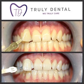 How much is laser teeth whitening
